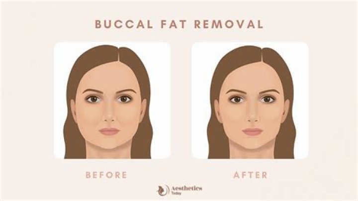 Buccal Fat Removal Celebs: The Ultimate Guide to Understanding and Transforming Facial Contours