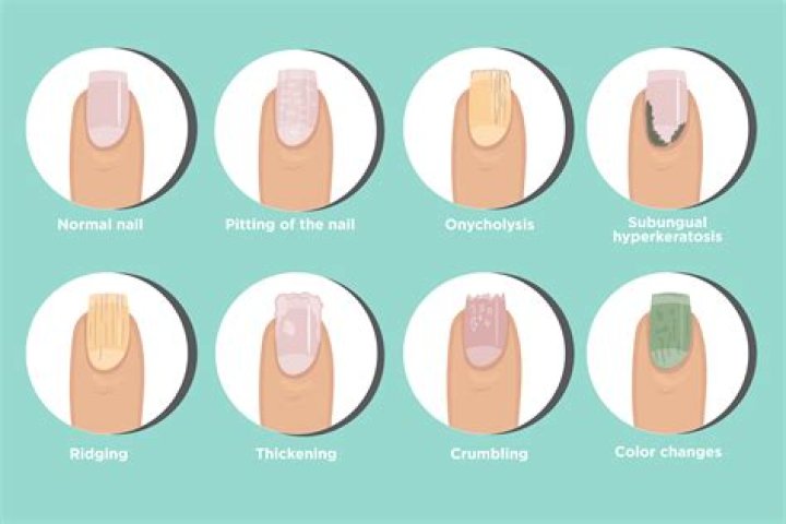 Nail Issues Ridges: Understanding Causes, Treatments, and Prevention