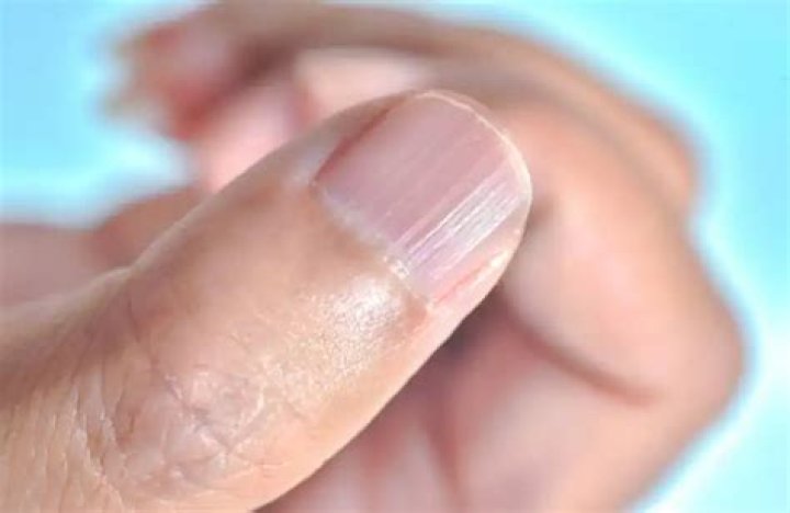 Vertical Lines in Nails Thyroid: Understanding the Connection